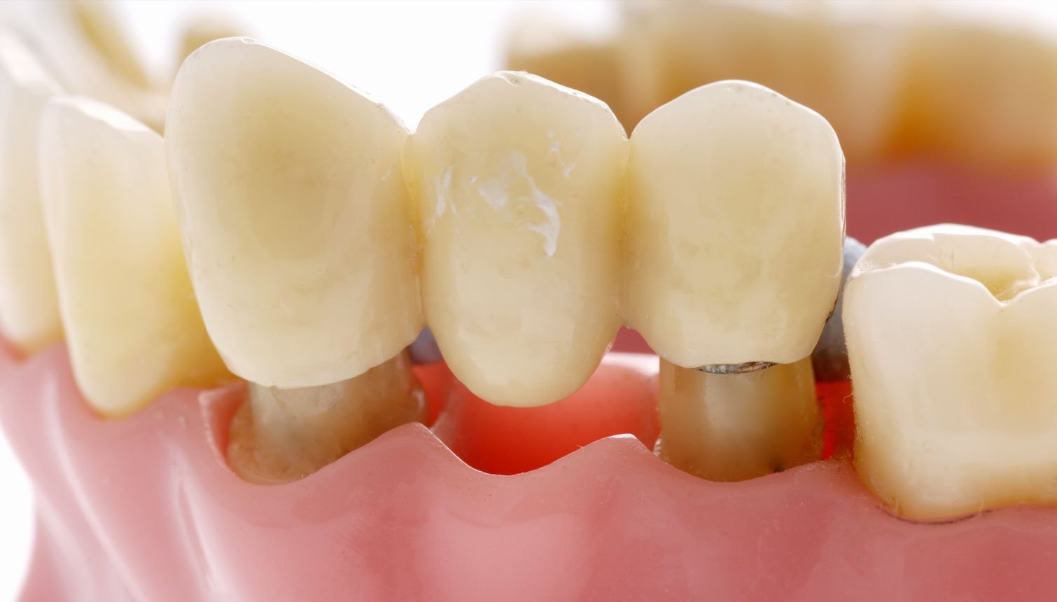 Dental Bridge at Deptford