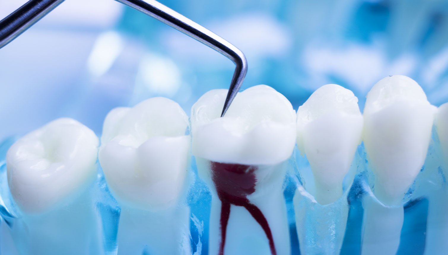 Root canal tretament Deptford